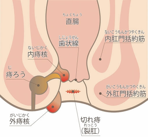 痔の種類