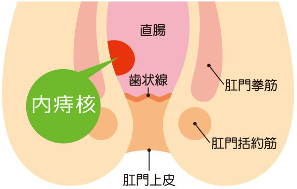 内痔核について