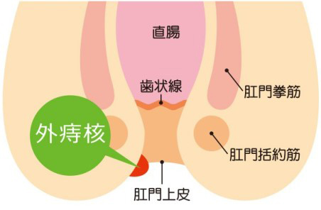 外痔核について