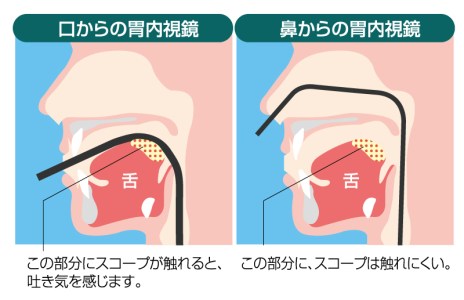 特徴1　負担が少ない経鼻内視鏡検査を行います